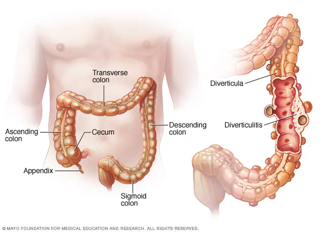 Diverticulitis Symptoms